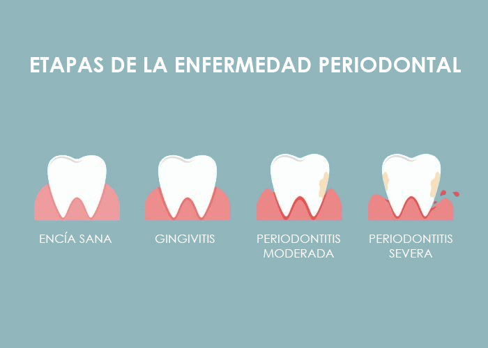 Enfermedad Periodontal – Salud dental con la Dr. Bernarda Alcántara