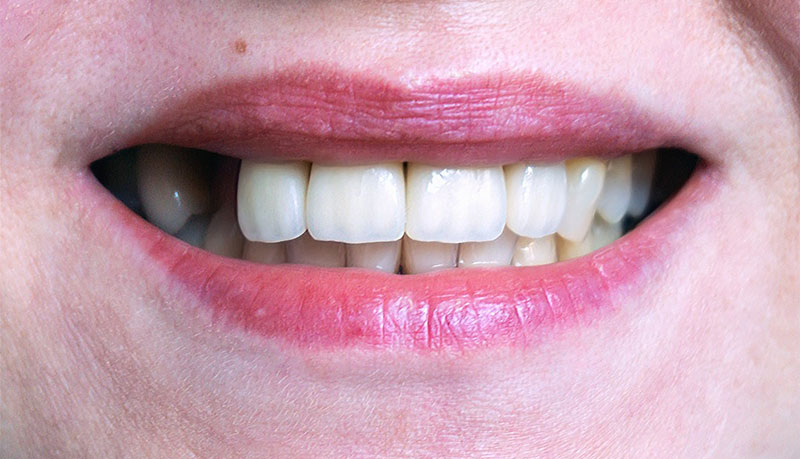 Reponer un diente ausente – Salud dental con la Dr. Bernarda Alcántara