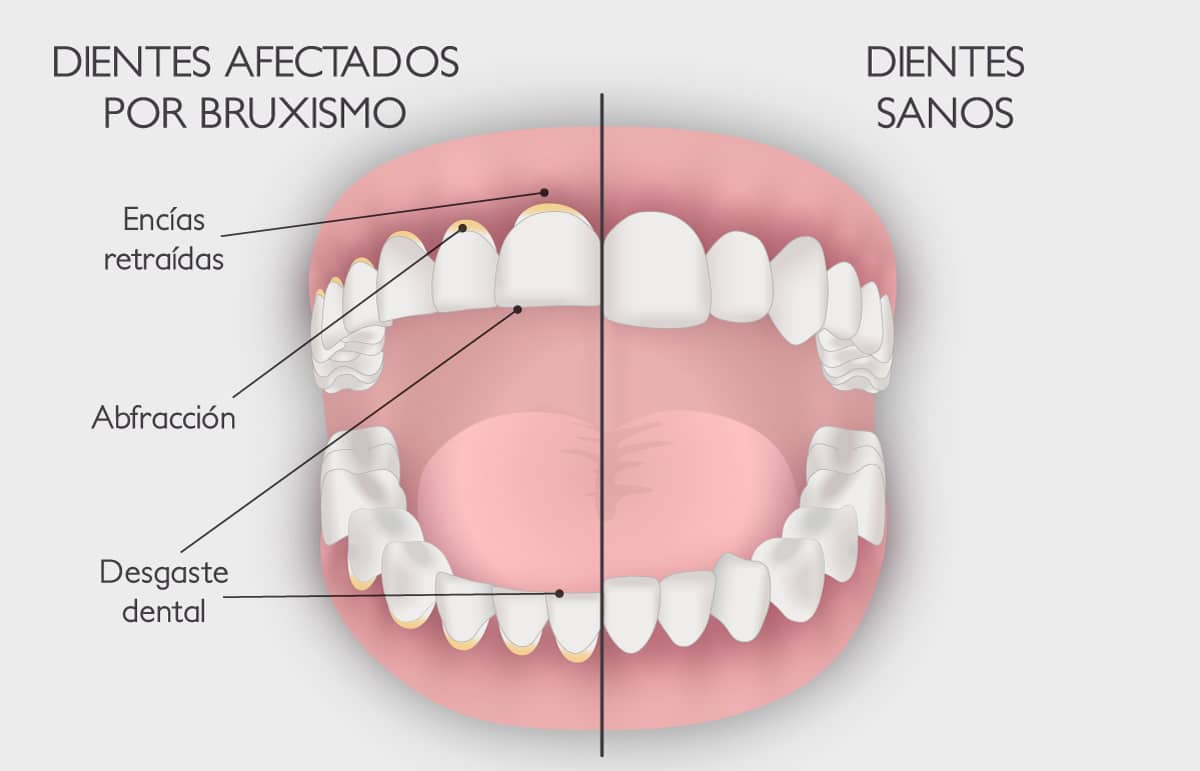 Bruxismo – Salud dental con la Dr. Bernarda Alcántara