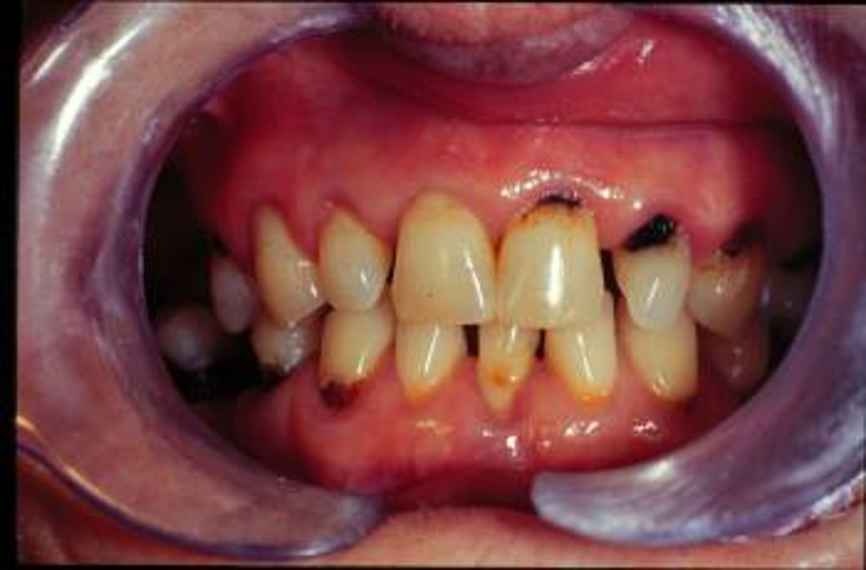 La enfermedad periodontal – Salud dental con la Dr. Bernarda Alcántara
